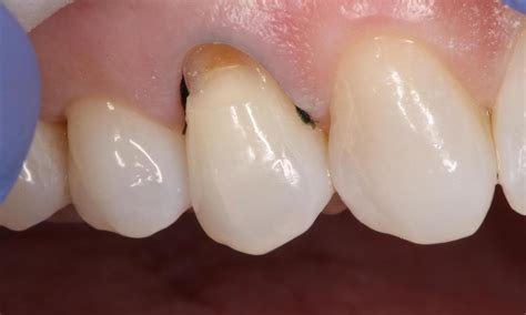 Fixing Old Fillings Dentist Houston Tx Tooth Colored Fillings