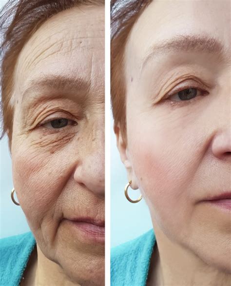 Radiofrequency Face Lifting Skin Tightening Treatments Farzanas Beauty