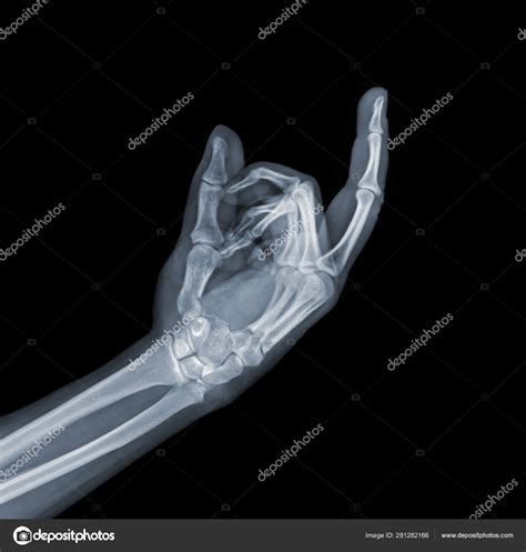 X Ray Hand Showing A Middle Finger Sign Stock Photo By Ealisa
