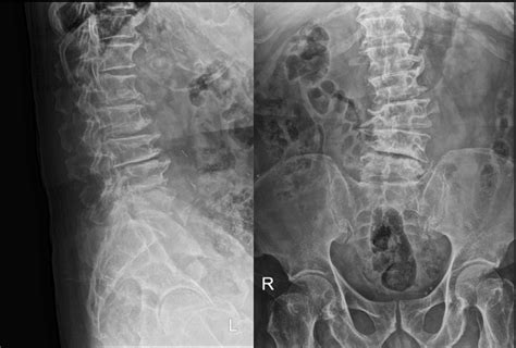 Lumbosacral Spine Radiography Ap And Lateral Views Showing Lumbar Download Scientific Diagram
