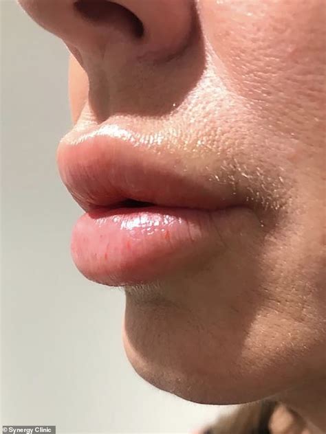 Woman Who Had Lip Fillers Reveals How Treatment Left Her With Nightmare