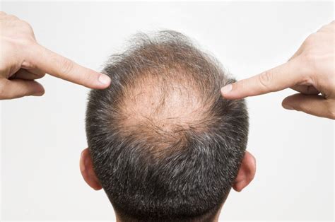 Can Anything Be Done To Slow Down The Balding Process Hair Treatments
