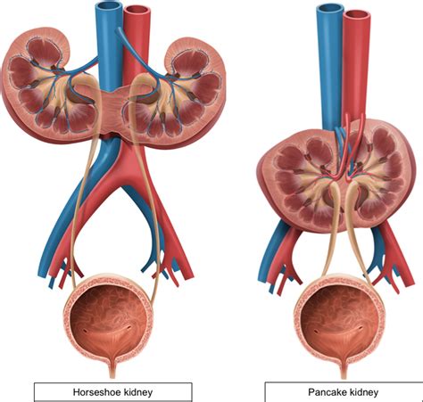 Congenital Anomalies Of The Upper Urinary Tract A Comprehensive Review