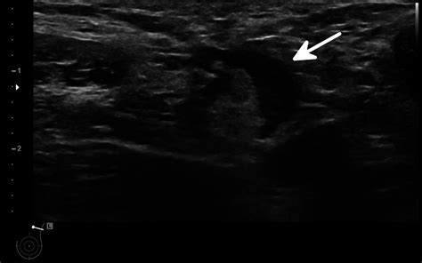 Axillary Lymphadenopathy At The Time Of Covid 19 Vaccination Ten