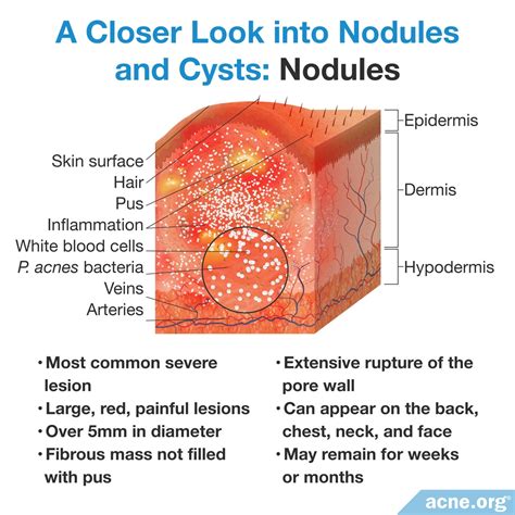 What Is Cystic Acne