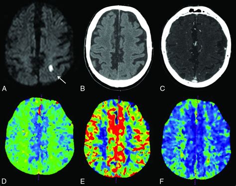 Ct Perfusion In Acute Lacunar Stroke Detection Capabilities Based On