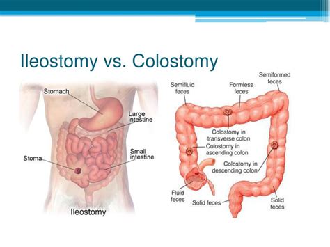 Seeking Healthy Life What Is An Ileostomy Surgery Types Of An Ileostomy