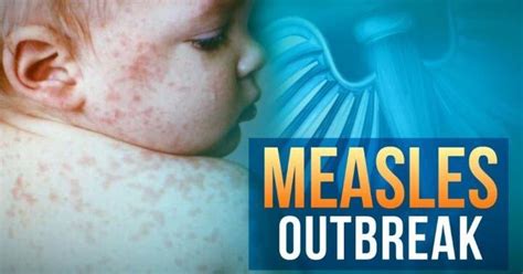 Us Measles Cases Reach Highest Number In Nearly Three Decades Cdc Says