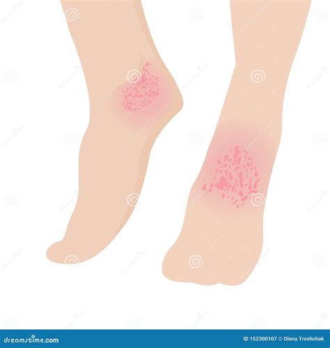 Eczema Affected A Foot Dermatology Skin Disease Concept Stock Vector