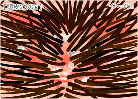 ふけ・頭のかゆみの対策｜くすりと健康の情報局