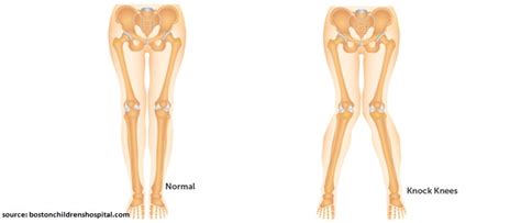 Knock Knees Everything You Need To Know Young Bones Clinic