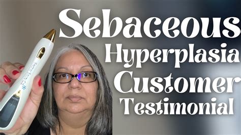 Successful Sebaceous Hyperplasia Removal At Home Customer Testimonial