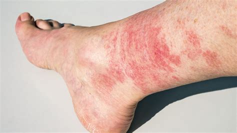 Diabetic Sores On Legs Causes Diagnosis And Prevention Tips