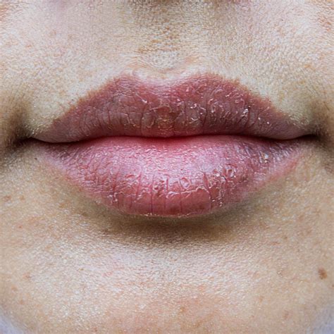 Dry Lips Treatment Causes Prevention Cure OKeeffes O Keeffe S UK