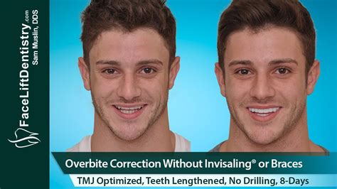 Overbite Correction No Braces Or Invisalign® No Surgery In 8 Days Youtube