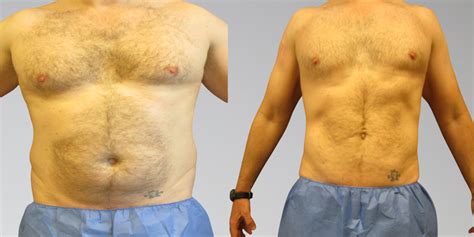 Before After Chest Liposuction Sono Bello Results