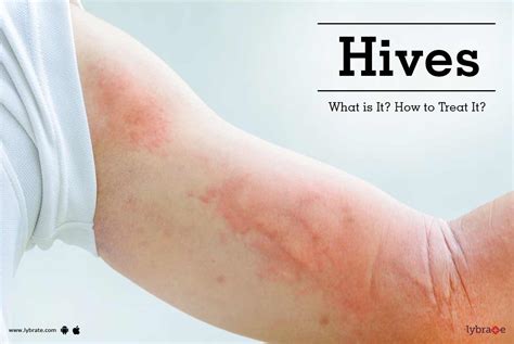 Hives What Is It How To Treat It By Dr Vikas Shankar Lybrate