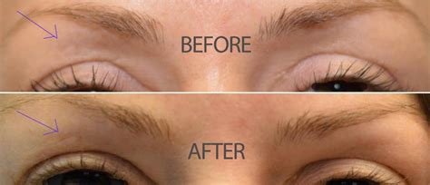 Upper Eyelid Filler To Fix Hollow After Upper Bleph