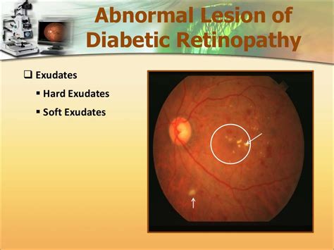Automatic Detection Of Diabetic Maculopathy From Fundus Images Using