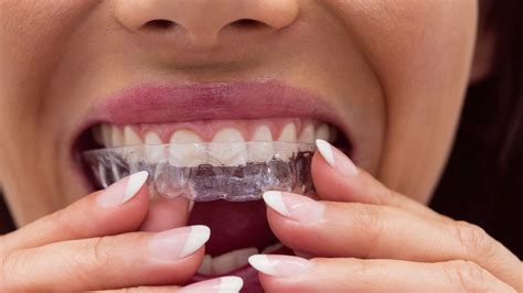 Invisible Braces Vs Metal Braces Which Is Better And Why Onlymyhealth