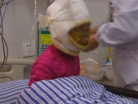 充电热水袋突然爆炸 8岁女童惨遭深度烫伤 面部颈部被烧通红 今日头条