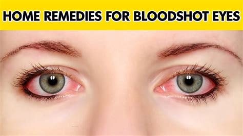 What Causes Bloodshot Eyes How To Get Rid Of Red Eyes Bloodshot
