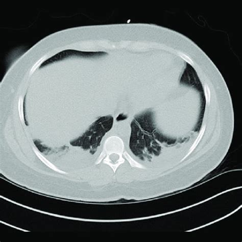 Ct Scan Of The Chest Image Without Contrast Showing Bibasilar