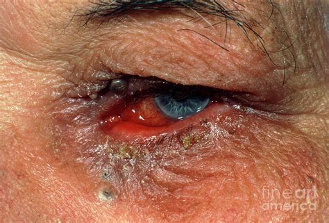 Chronic Conjunctivitis Caused By Ectropion Photograph By Dr Chris Hale