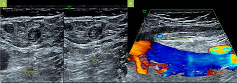 Cureus Isolated Great Saphenous Vein Thrombosis In A Patient With