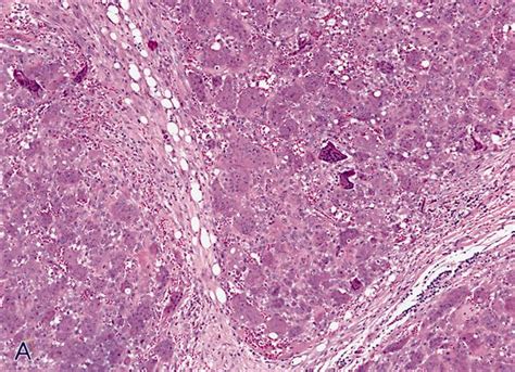 Pathology Outlines Giant Cell Tumor Of Soft Tissue