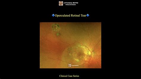 Operculated Retinal Tear Youtube