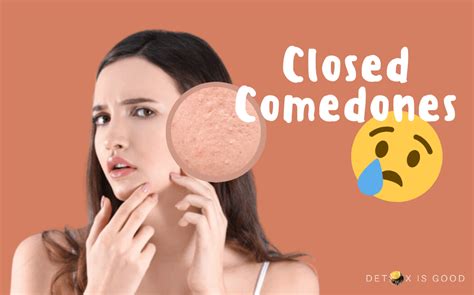 Pimples can occur anywhere on the face and forehead. How to Get Rid of Closed Comedones? (+ Natural Remedies)