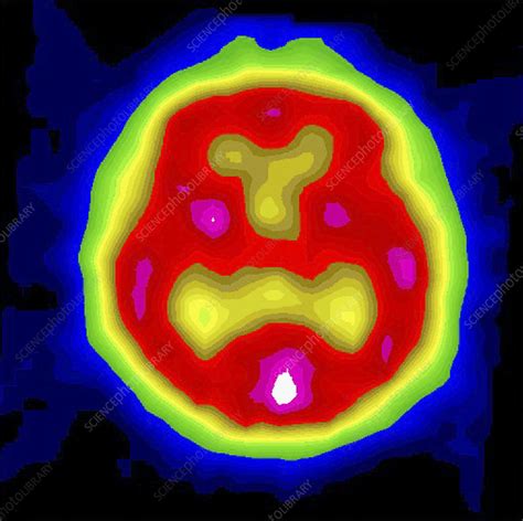 Healthy Brain Spect Scan Stock Image P3320426 Science Photo Library