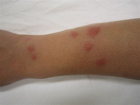 Identifying Insect Bites And Stings