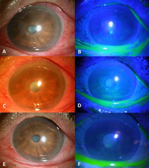 Clinical Course Of Case 3 The Refractory Corneal Epithelial Defect In