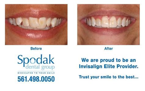 Invisalign Results In Just Six Months Invisalign Teeth Invisalign