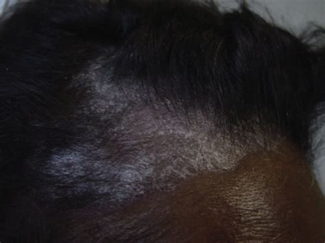 Fungos No Cabelo Que Parece Lendeas