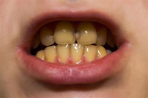 Yellow Teeth Stock Image Image Of Dental Weird Gingivitis 11658263