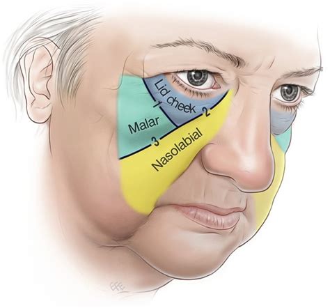 Facelift Anatomy Smas Retaining Ligaments And Facial Spaces