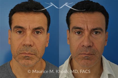 10 Nasal Valve Collapse Surgery Before And After Saphireammara