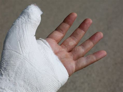 Hand Plastered After A Fracture Due To An Accident Stock Image Image