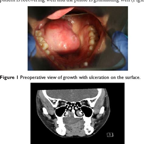 Figure 1 From Successful Management Of A Rare Palatal Tumor Preventing