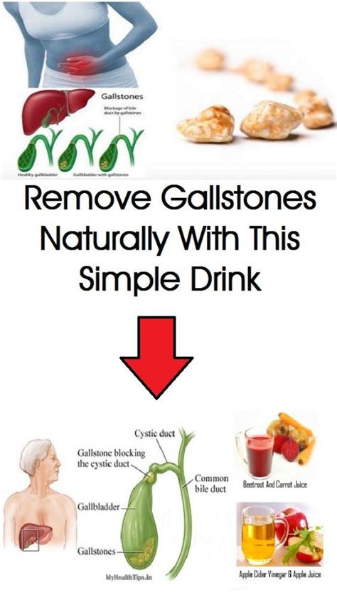 Pin By Judy Gunasekera On Health Tips And Wellness Guide Gallstones