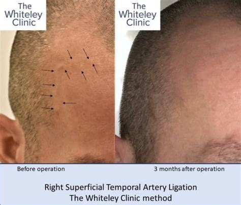 Removal Bulging Superficial Temporal Arteries The Whiteley Clinic