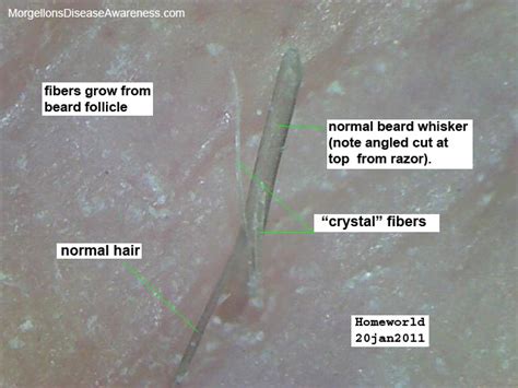 Morgellons Disease Awareness Morgellons Fibers Skin Many People Have