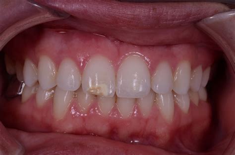Direct Composite Bonding | Williams Family Dentistry - Family Dentist ...