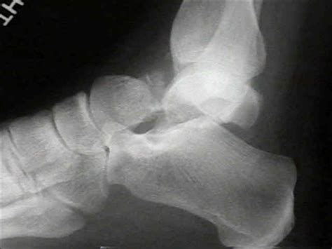 Talar Neck Fractures Trauma Orthobullets