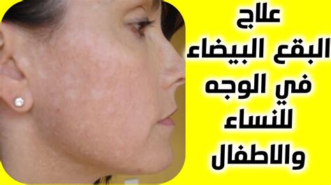 علاج البقع البيضاء في الوجه النخالة البيضاء 7 وصفات فعالة للتخلص
