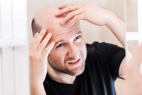 Male Alopecia A Man With A Bald Head Rear View Gray Background Stock