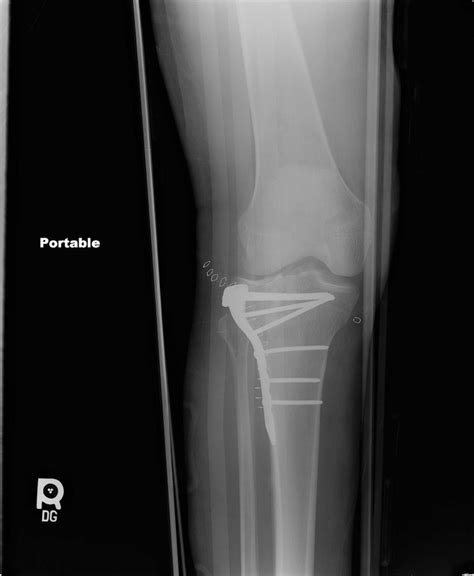 Right Tibial Plateau Fracture